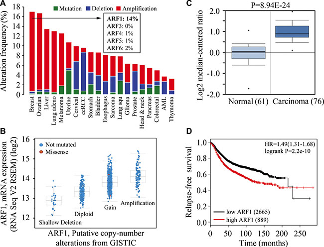 High-level amplification of ARF1 is associated with increased mRNA expression and poor outcomes of patients with breast cancer.