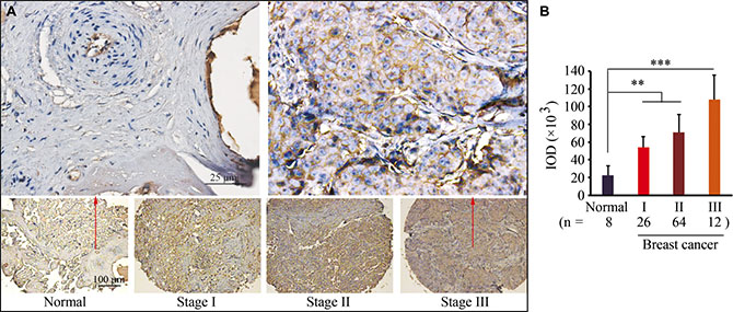 ARF1 is upregulated in human breast cancer tissues.