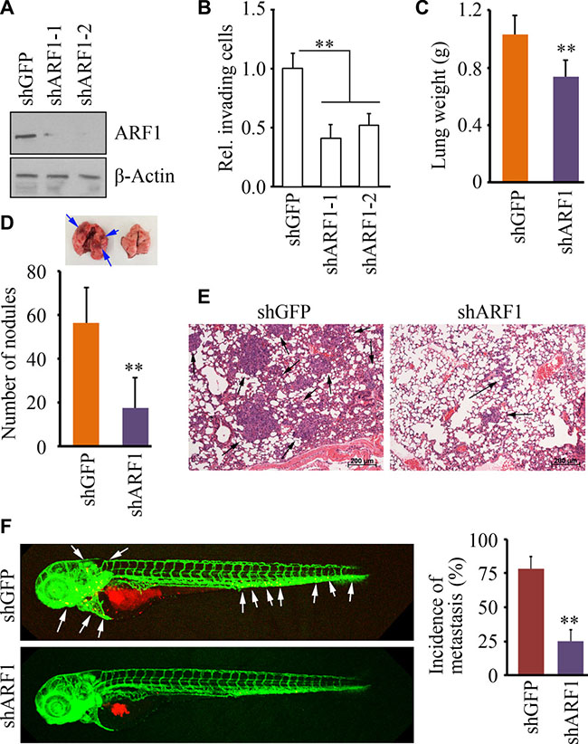 Knockdown of ARF1 leads to reduced cell invasion and metastasis in breast cancer.