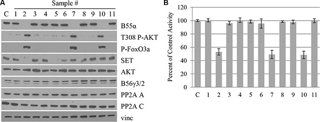 B55&#x03B1; mutation correlates with loss of B55&#x03B1; expression, decreased PP2A activity and enhanced AKT phosphorylation in leukemic blasts.