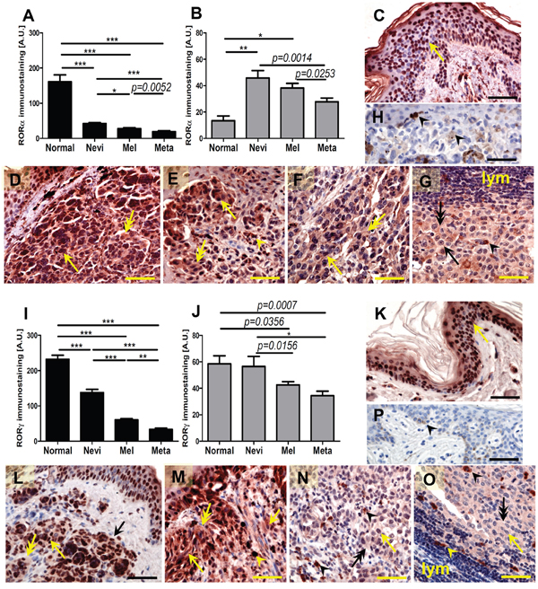 The mean level of nuclear (A, I) and cytoplasmic (B, J) ROR&#x03B1; (A, B) and ROR&#x03B3; (I, J) in keratinocytes of normal skin, melanocytic cells of nevi, primary melanomas (MM) and metastases (meta).