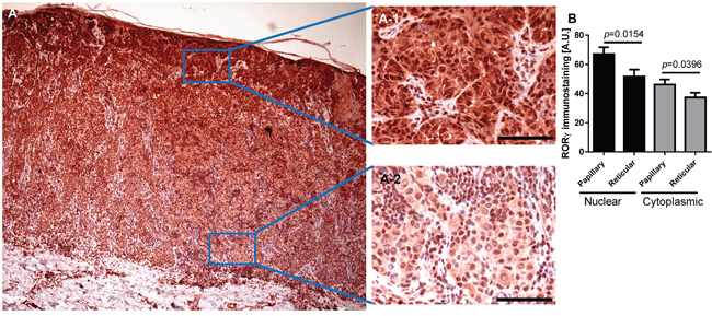 Representative immunostaining of ROR&#x03B3; in melanoma.