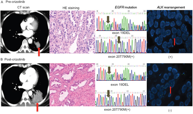 Changes of driver genes in EGFR/ALK-coexisting patient treated with crizotinib.