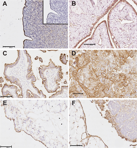 Annexin A2 immunostaining in human ovarian tissues and omental tissues.