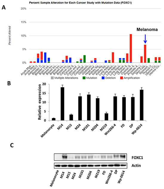 FOXC1 expression in melanoma.