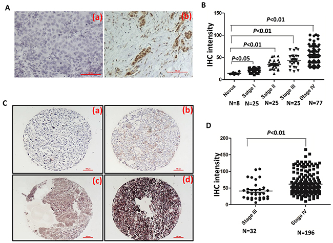 FOXC1 expression is associated with progress of melanoma.