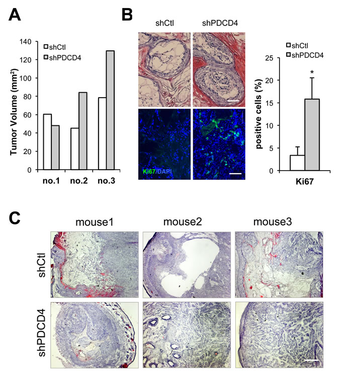 PDCD4 depleted fibroblasts enhance tumorigenic behavior of keratinocyte-derived SCC cells.