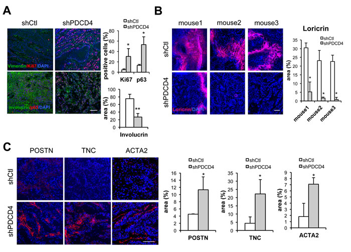 Dermal fibroblasts with PDCD4 gene silencing promote formation of SCC with higher proliferative index and suppressed differentiation.