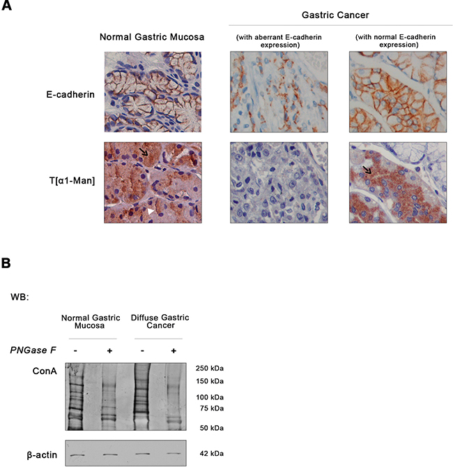 Expression of E-cadherin and O-mannosyl glycans in human normal gastric mucosa and diffuse gastric cancer.