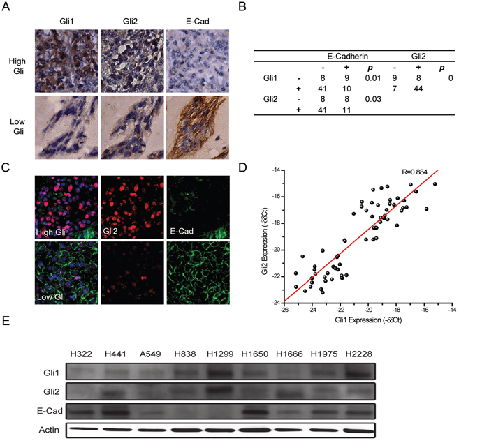 Gli expression inversely correlates with E-Cadherin expression in lung adenocarcinoma.