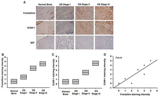 Fractalkine expression is significant correlated with ICAM-1 and tumor stage in osteosarcoma specimens.
