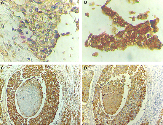 STn overexpression co-localizes with high nuclear HIF-1&#x03B1; expression areas.