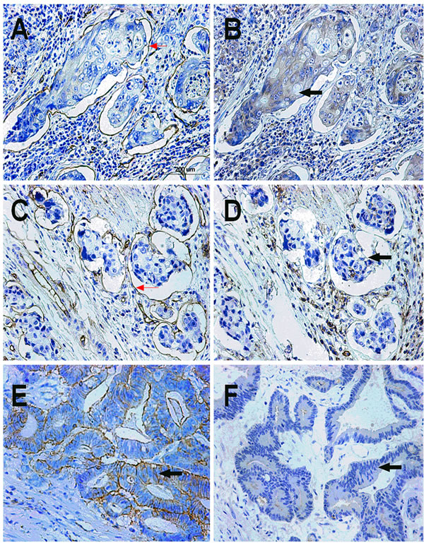 CD133 expression status in IVE and non-IVE colorectal cancer tissues.