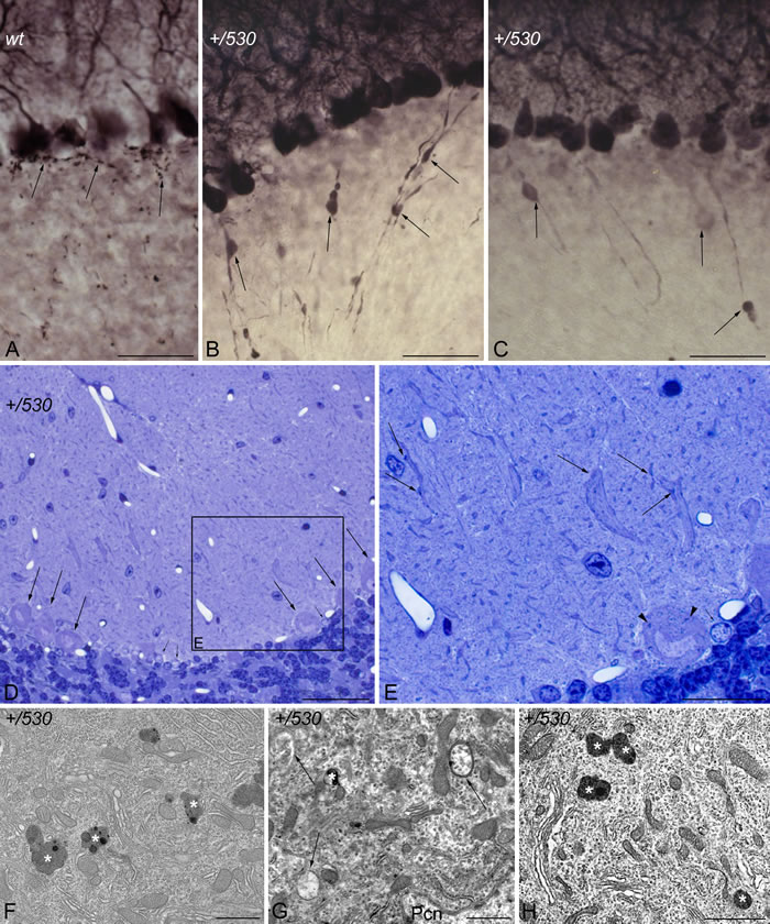 Purkinje cell degeneration in