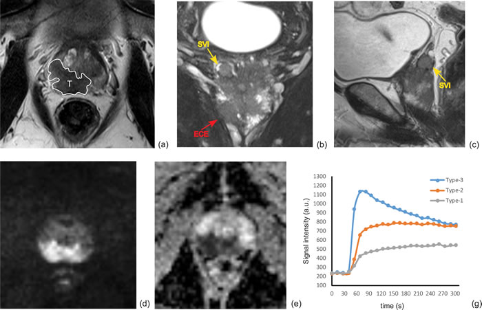 A multi-parametric prostate MRI in a 68-year-old man (PSA of 34.3 ng/ml, biopsy Gleason score 4+3 and stage T3b) to show the metrics for imaging interpretation.