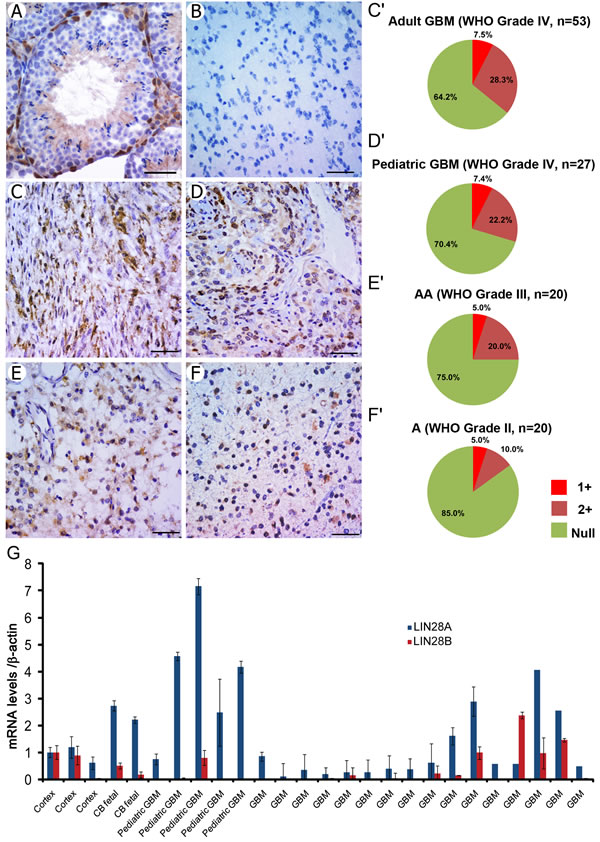 LIN28A protein is expressed in human primary glioma samples, with highest expression in GBM and anaplastic astrocytoma.