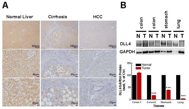 Immunohistochemistry and densitometric analyses of DLL4 expression in normal, cirrhotic and tumor tissues.