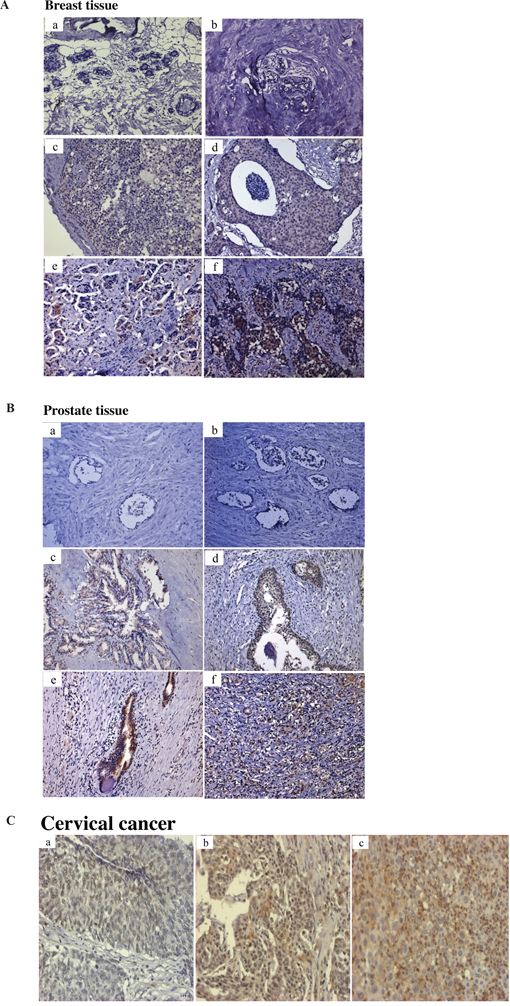 Immunohistochemical analysis of Tn antigen in breast, prostate and cervical tissues.