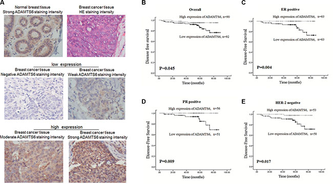 High expression of ADAMTS6 is associated with favorable prognosis of BC patients.