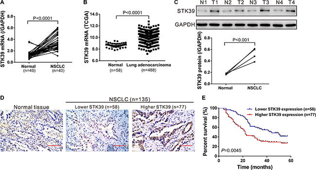 STK39 overexpression correlates with poor survival in patients with NSCLC.