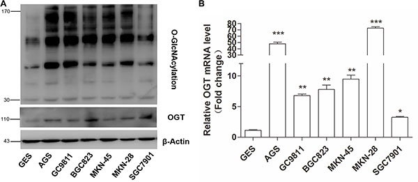 Gastric cancer cells exhibit elevated O-GlcNAcylation and OGT levels.