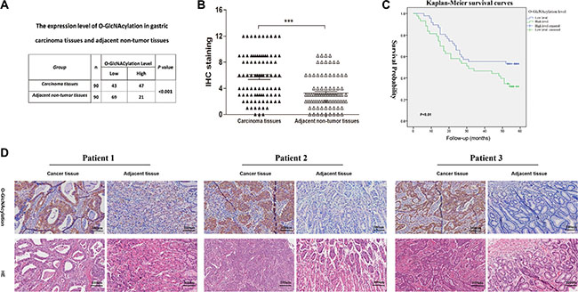 The O-GlcNAcylation levels are positively correlated with the malignancy of gastric cancer.