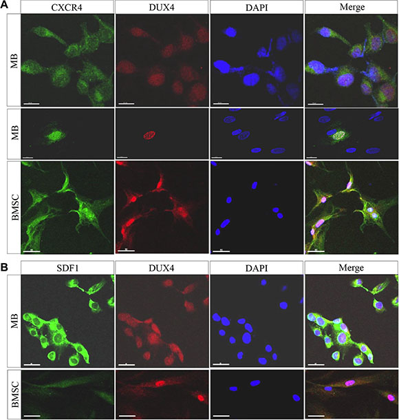 DUX4-transfected cells overexpress SDF1 and CXCR4.