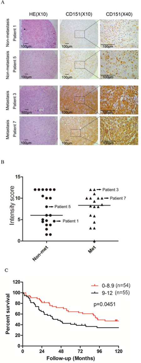 CD151 protein expression in human osteosarcoma.