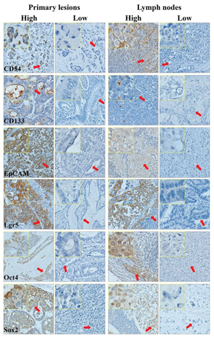 Immunohistochemistry of primary lesions and metastatic lymph nodes of gastric cancer.