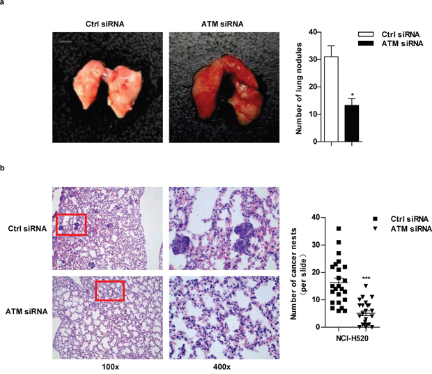 ATM inhibition decrease lung cancer metastasis.