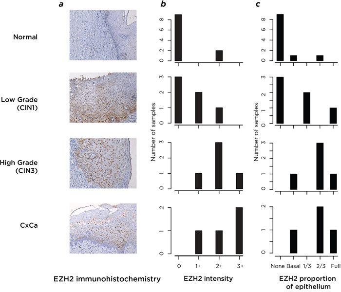 Analysis by immunohistochemistry of the expression of the polycomb protein EZH2.