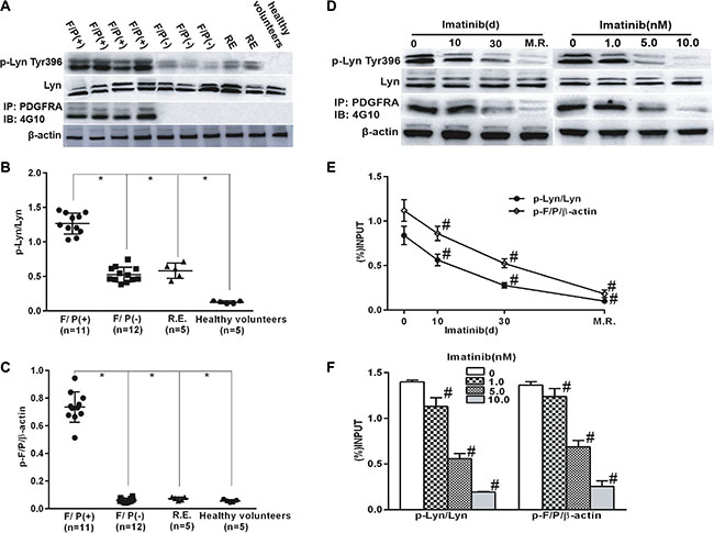 Lyn activation in F/P(+) CEL patients and was inhibited with the reduction in phosph-F/P by imatinib treatment.