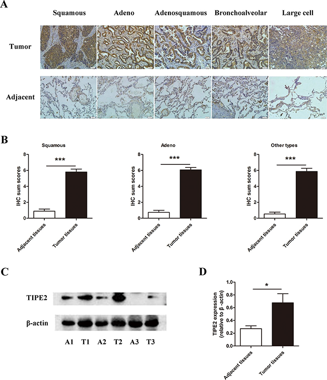 The expression of TIPE2 in NSCLC tissues.