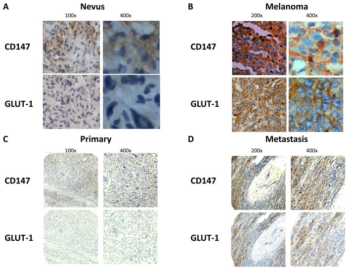 CD147 and GLUT-1 were overexpressed in melanoma compared with nevus