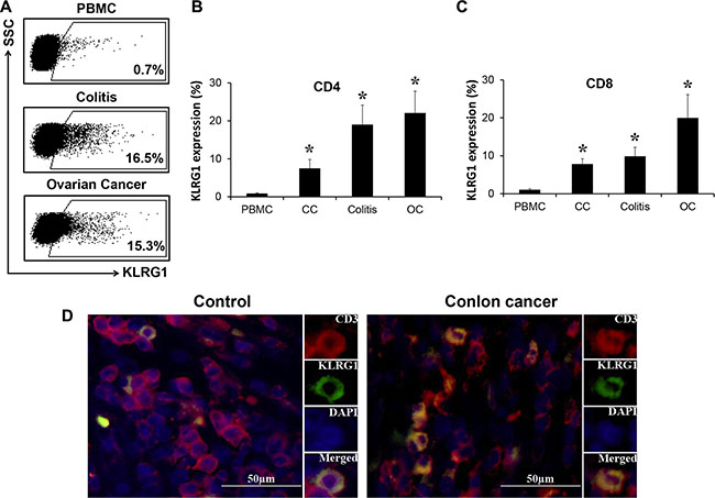 KLRG1+ T cells enriched in tumor microenvironment.