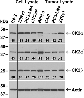 Expression of CK2 protein complex members in malignant and benign prostatic hyperplasia prostate cells.