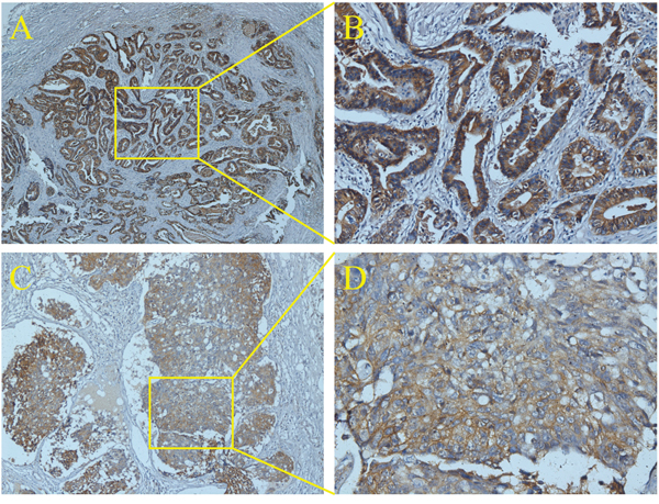 The histology of ENM by immunohistochemistry of EpCAM.