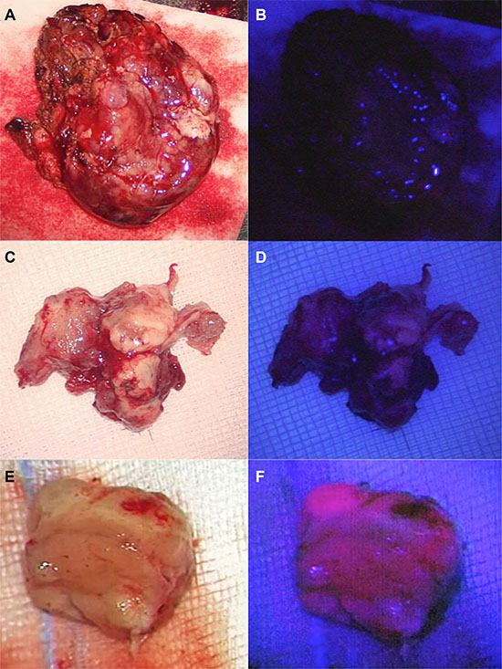 Different shades of 5-ALA-induced fluorescence of cerebral metastases.