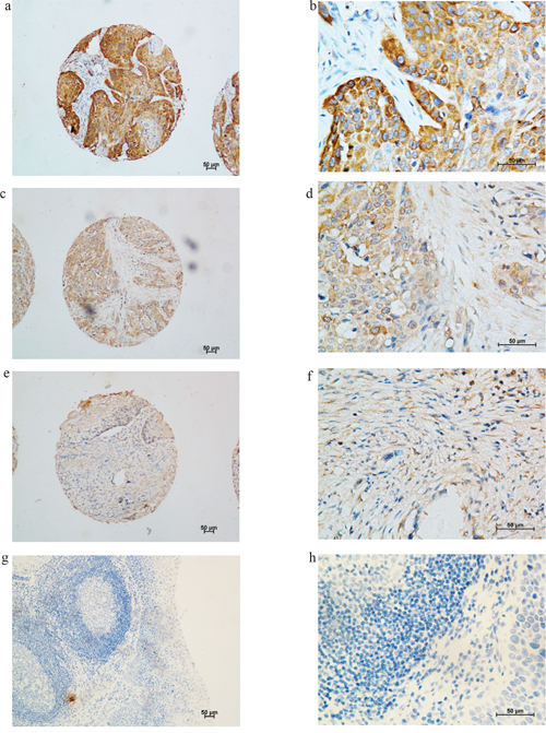 Immunohistochemical analysis of KIF-2C expression in tumor tissues and adjacent non-cancerous tissues of patients with esophageal squamous cell carcinoma (ESCC).