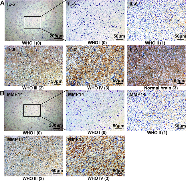 IL-6 and MMP14 are highly expressed in high grade gliomas from patients.