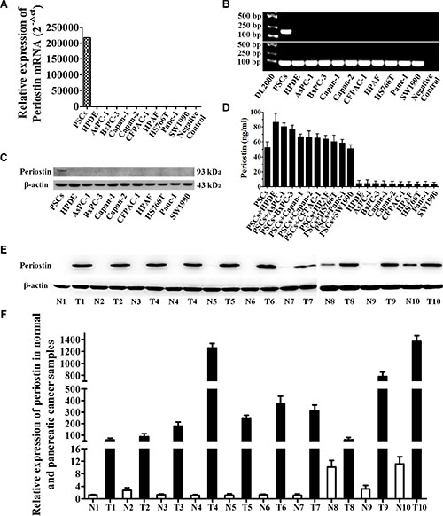 Periostin is exclusively expressed in PSCs and PDAC stroma.