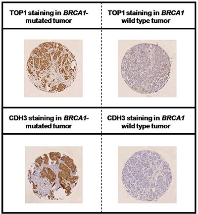 Immunohistochemical staining of TOP1 and CDH3 in BRCA1-deficient and proficient breast cancer.