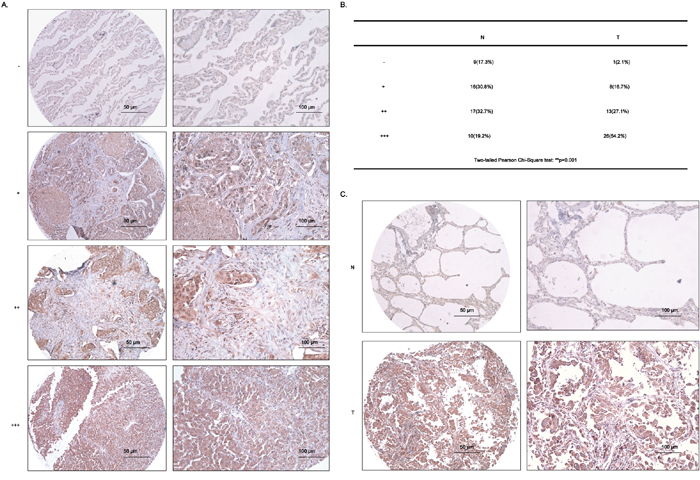 RAD51 is highly upregulated in lung adenocarcinoma tissues.
