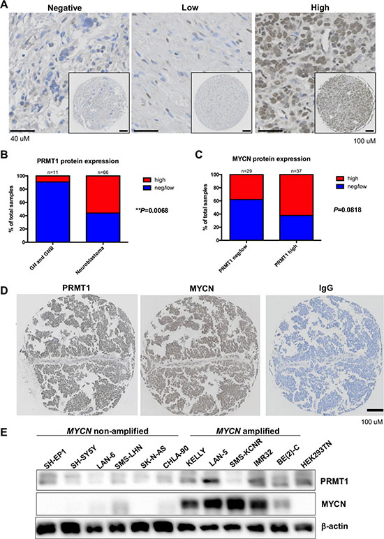 MYCN and PRMT1 correlations in neuroblastomas.