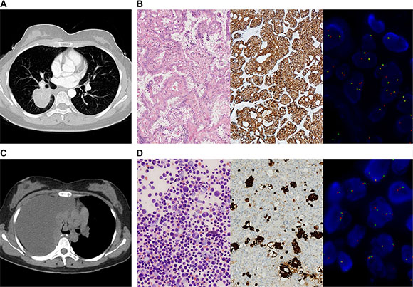 IHC and FISH confirmed the presence of ALK rearrangements in tumor tissue and cell block.