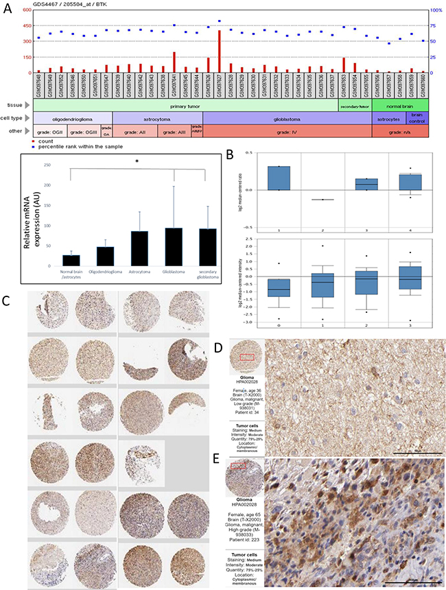 Figure 1. An elevated Btk expression is found in clinical GBM samples.