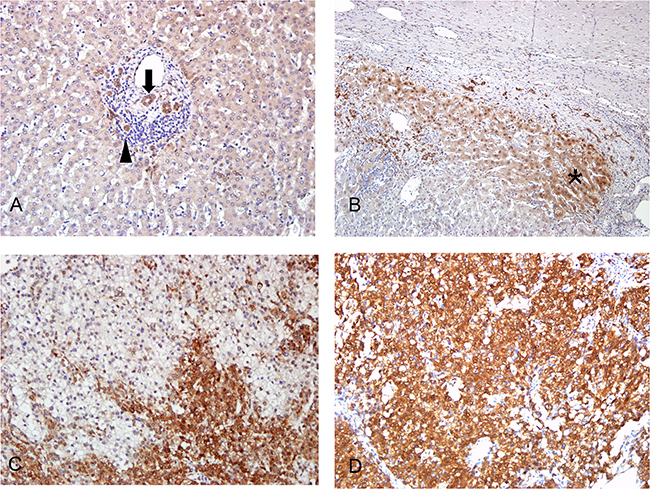 Immunostaining of MBNL2 in non-cancerous liver parenchyma and HCC.