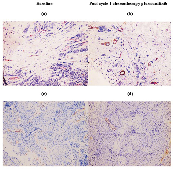 Immunohistochemistry staining was performed at baseline and after one cycle of chemotherapy plus sunitinib in a representative patient (200x magnification).