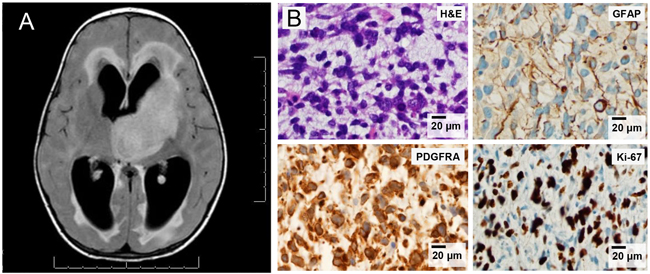 Clinical detail for infant with thalamic pediatric HGG (UMPED05).