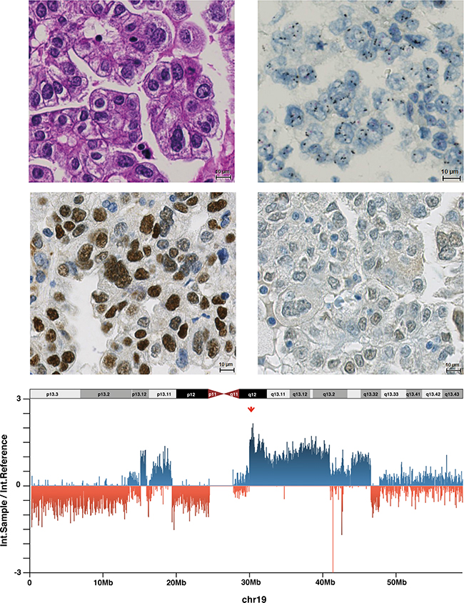 Endometrial cancer (Case 33) with 19q12 amplification, high Cyclin E1 expression, URI negativity and high 19q12 copy number.